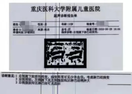 恶性肌纤维母细胞性肉瘤，获重疾险理赔80万(图1)